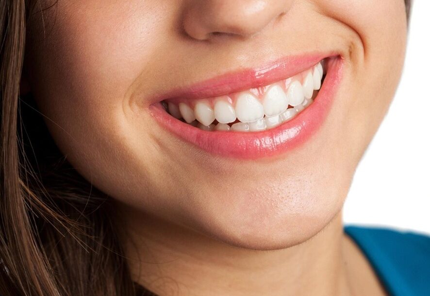 Clareamento Dental: Tudo o que Você Precisa Saber para um Sorriso Brilhante